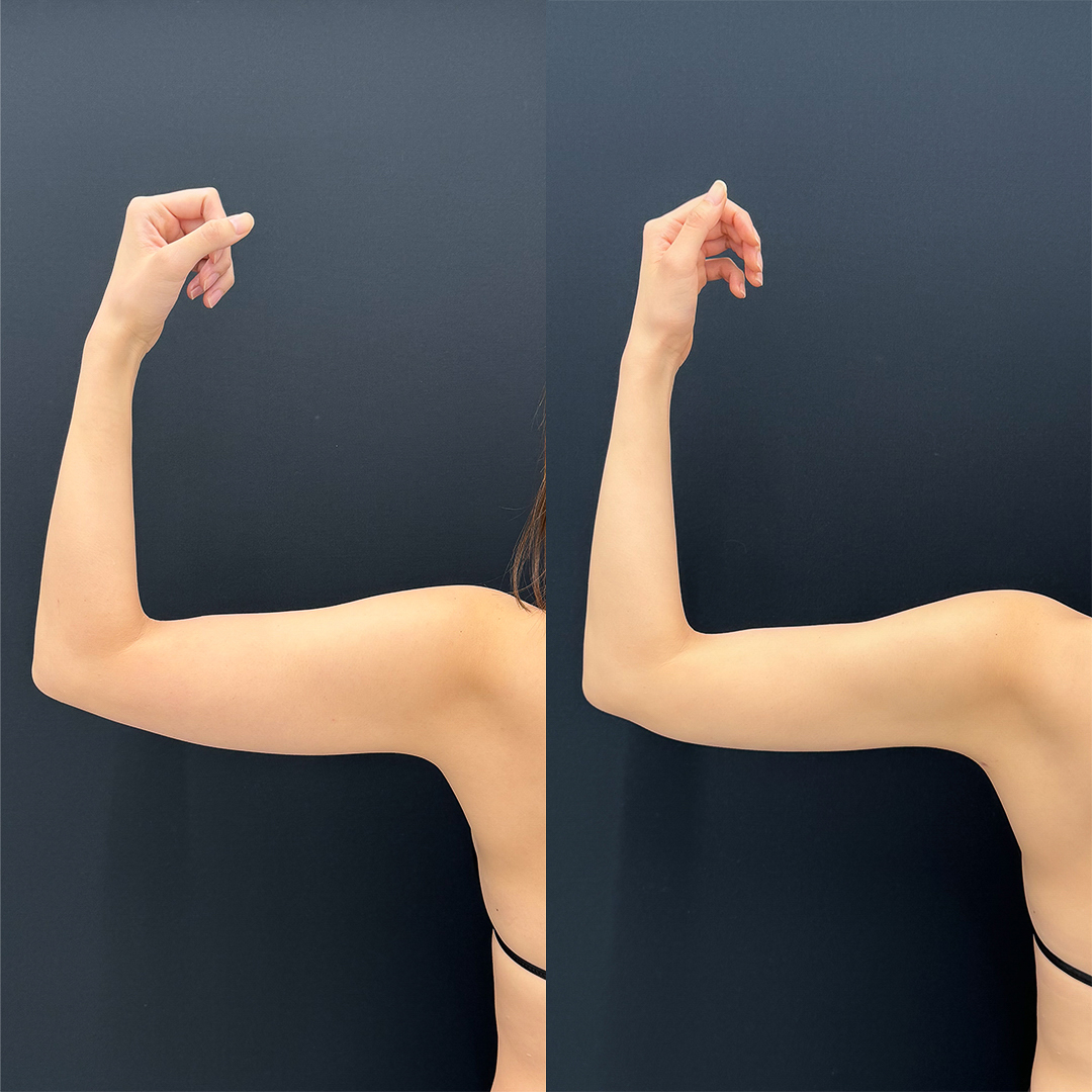 https://purelys-tokyo-clinic.com/wp/wp-content/uploads/2025/10/arm-Liposuction_Case-No.40.jpg