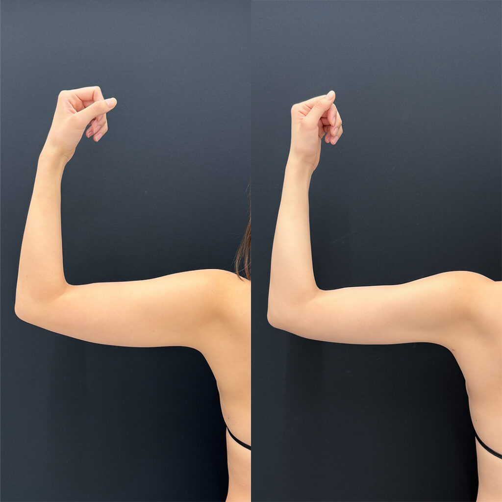 二の腕の脂肪吸引