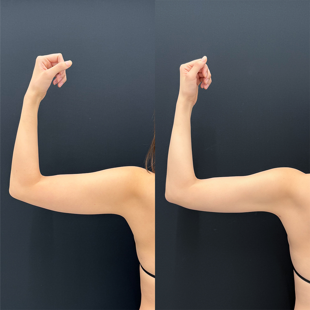 二の腕の脂肪吸引