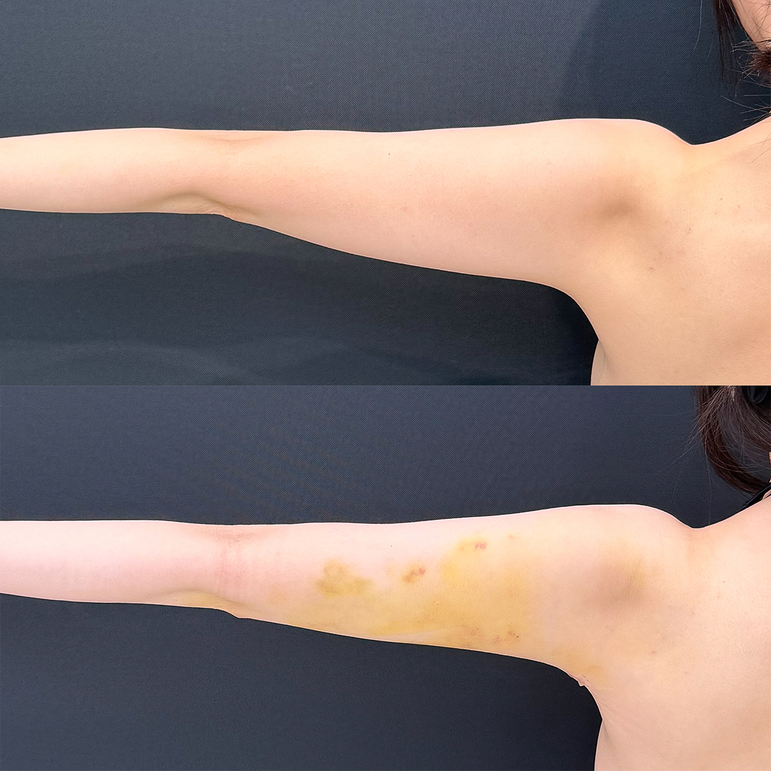 https://purelys-tokyo-clinic.com/wp/wp-content/uploads/2025/10/arm-Liposuction_Case-No.42.jpg