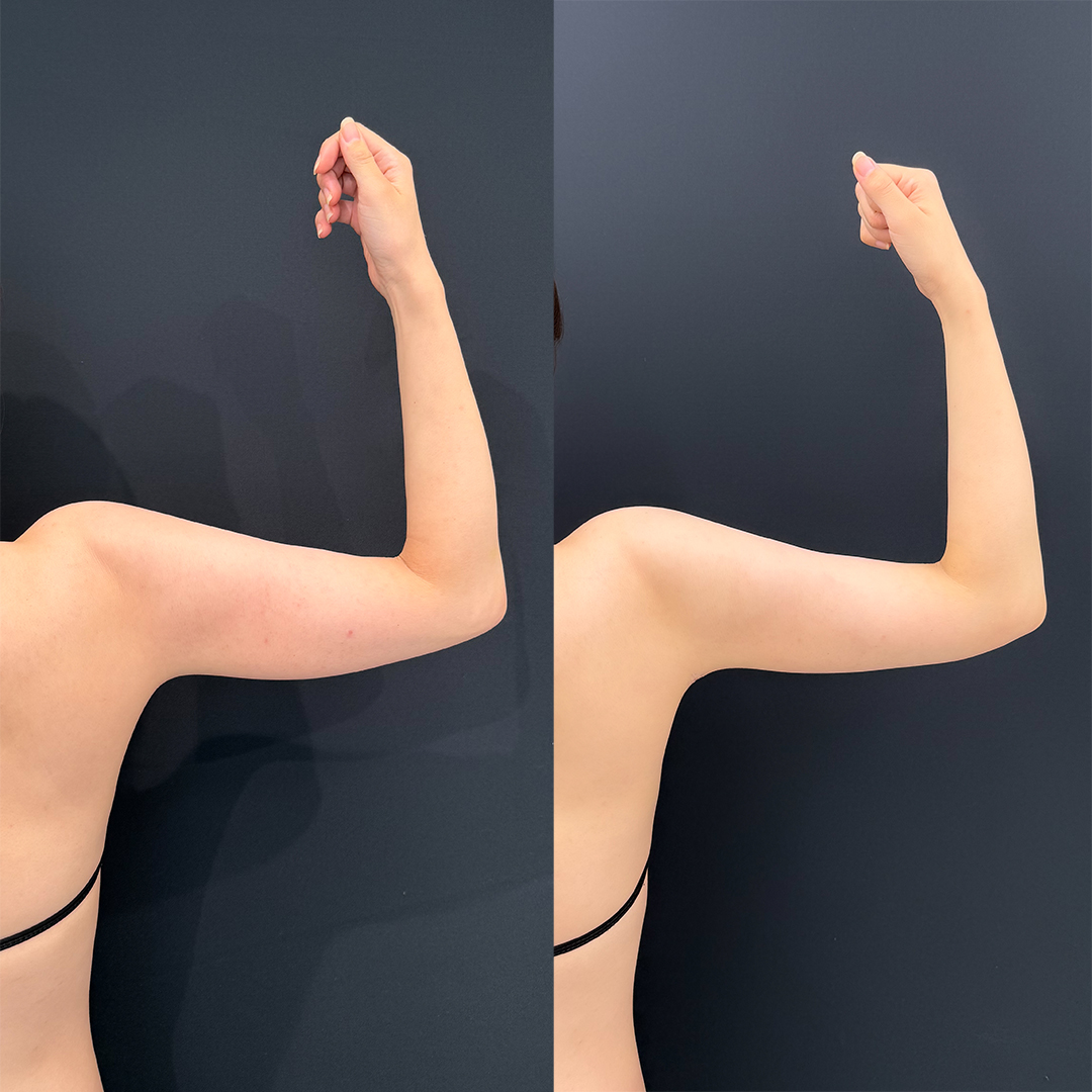 https://purelys-tokyo-clinic.com/wp/wp-content/uploads/2025/10/arm-Liposuction_Case-No.60.jpg