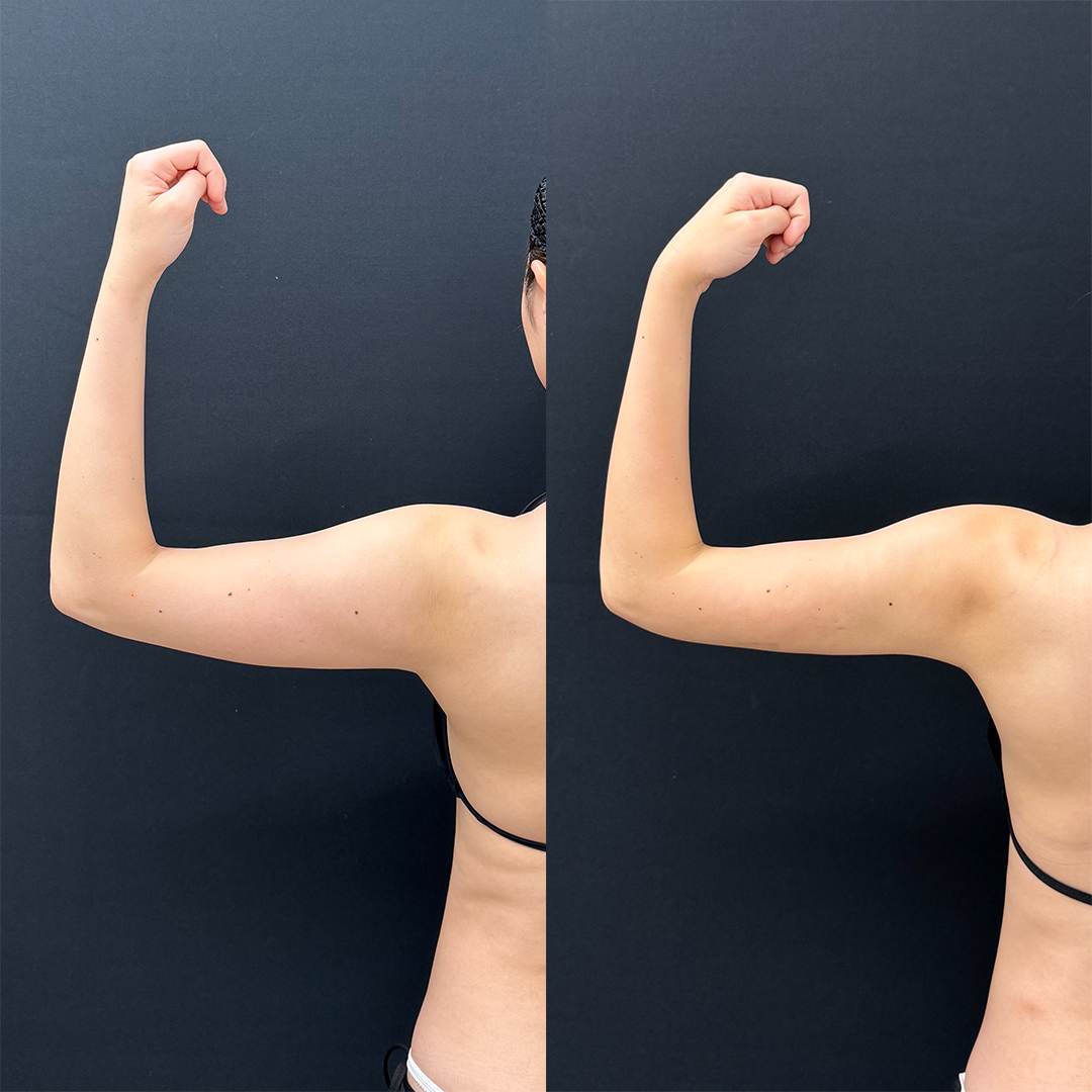 https://purelys-tokyo-clinic.com/wp/wp-content/uploads/2025/10/arm-Liposuction_Case-No.71.jpg