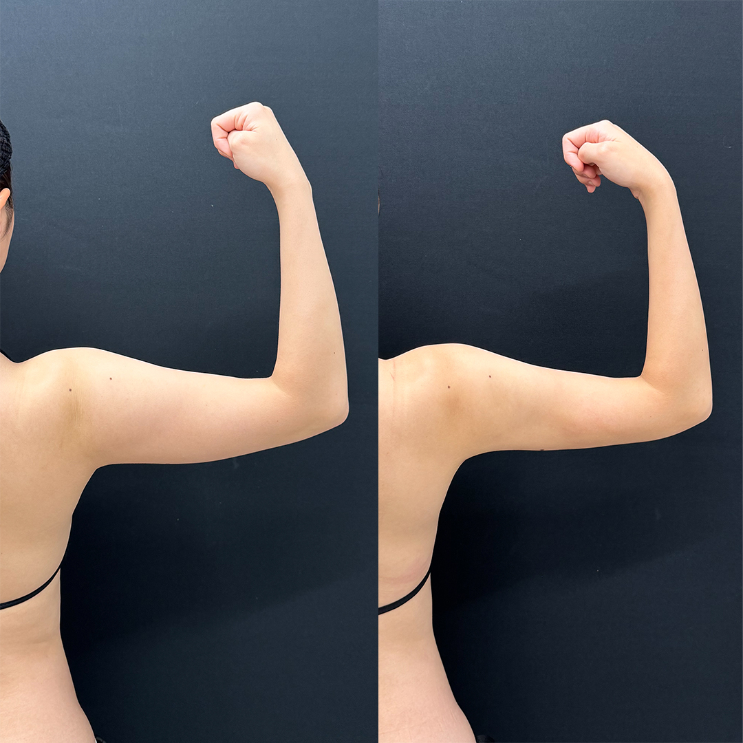 https://purelys-tokyo-clinic.com/wp/wp-content/uploads/2025/10/arm-Liposuction_Case-No.72.jpg