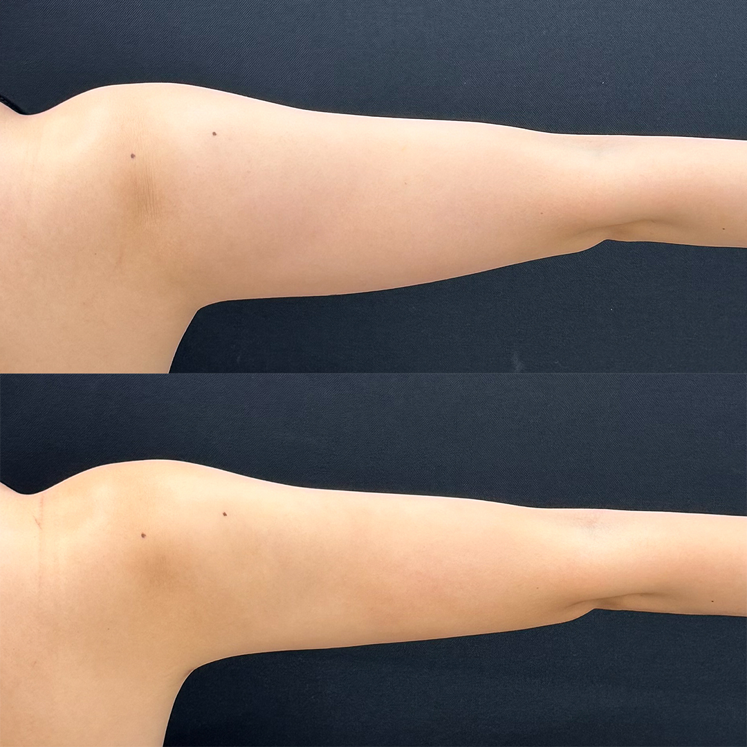 https://purelys-tokyo-clinic.com/wp/wp-content/uploads/2025/10/arm-Liposuction_Case-No.74.jpg