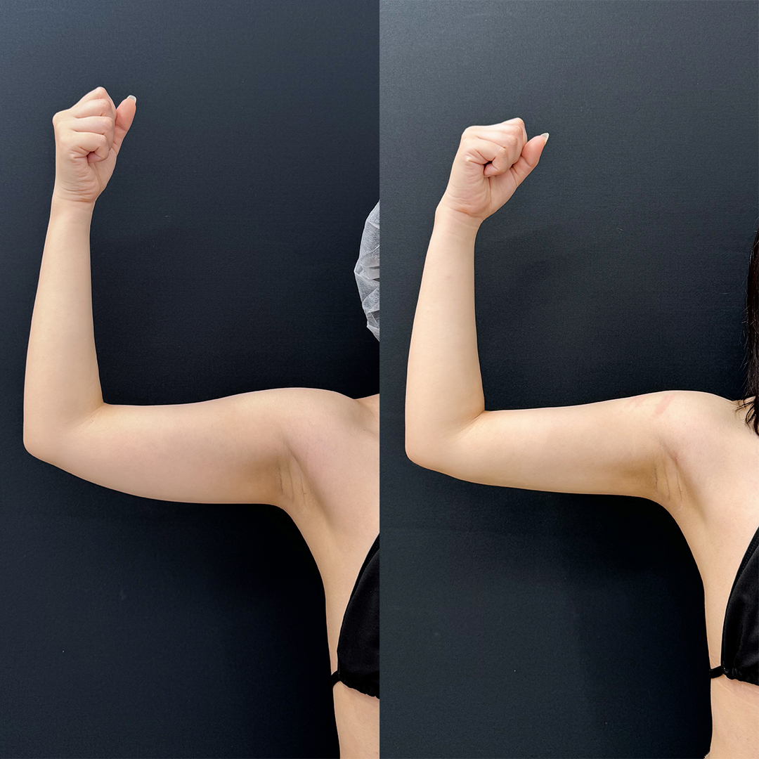 https://purelys-tokyo-clinic.com/wp/wp-content/uploads/2025/10/arm-Liposuction_Case-No.75.jpg