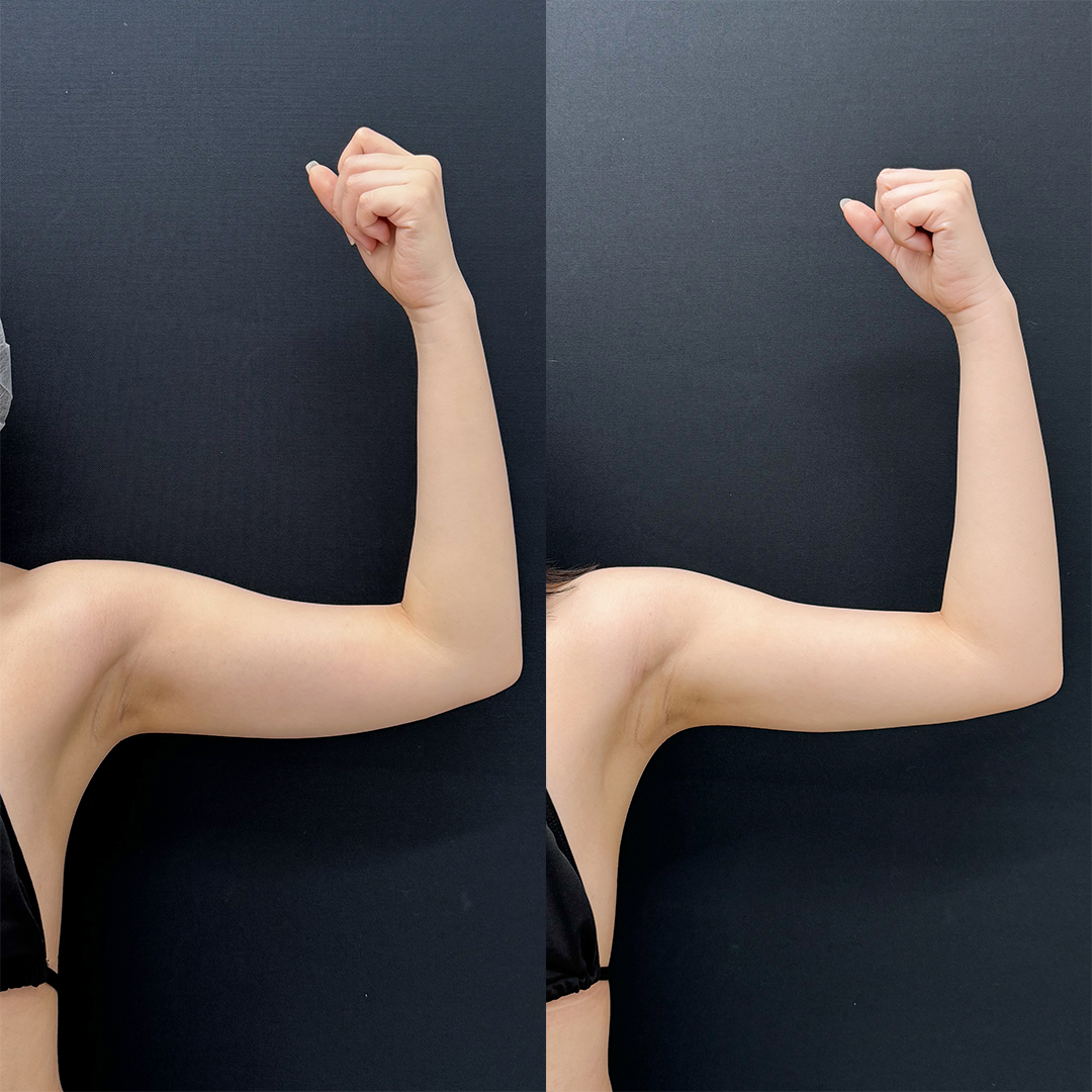https://purelys-tokyo-clinic.com/wp/wp-content/uploads/2025/10/arm-Liposuction_Case-No.76.jpg