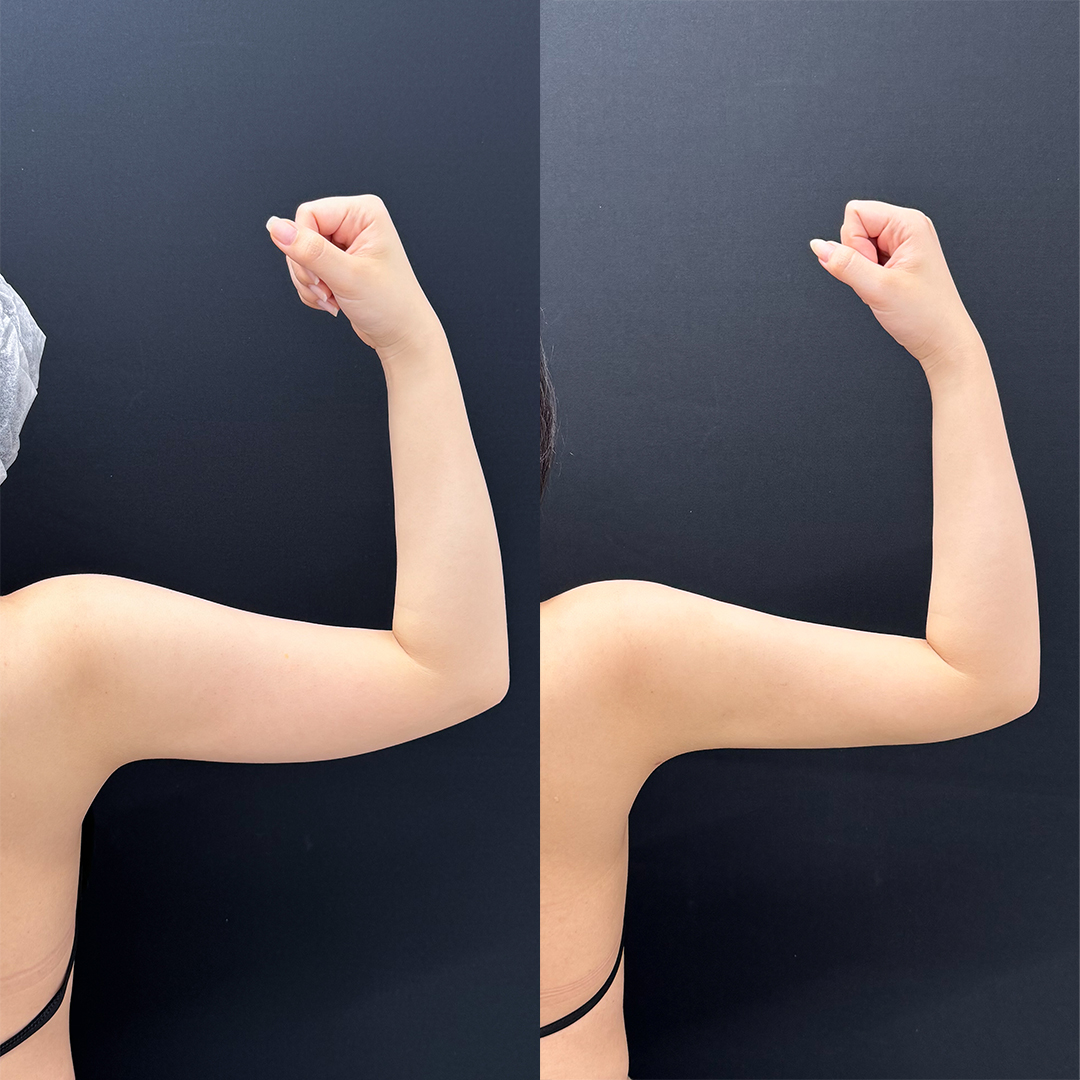 https://purelys-tokyo-clinic.com/wp/wp-content/uploads/2025/10/arm-Liposuction_Case-No.78.jpg