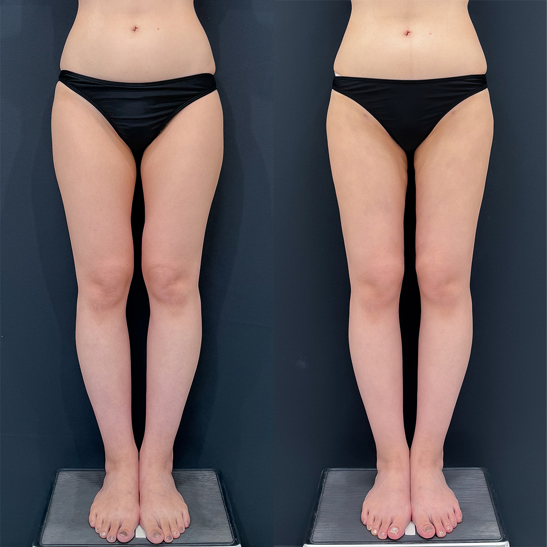 https://purelys-tokyo-clinic.com/wp/wp-content/uploads/2025/10/breast-augmentation_Case-No.16.jpg