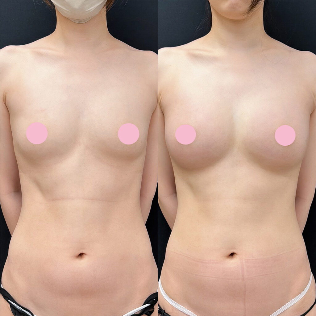 脂肪豊胸