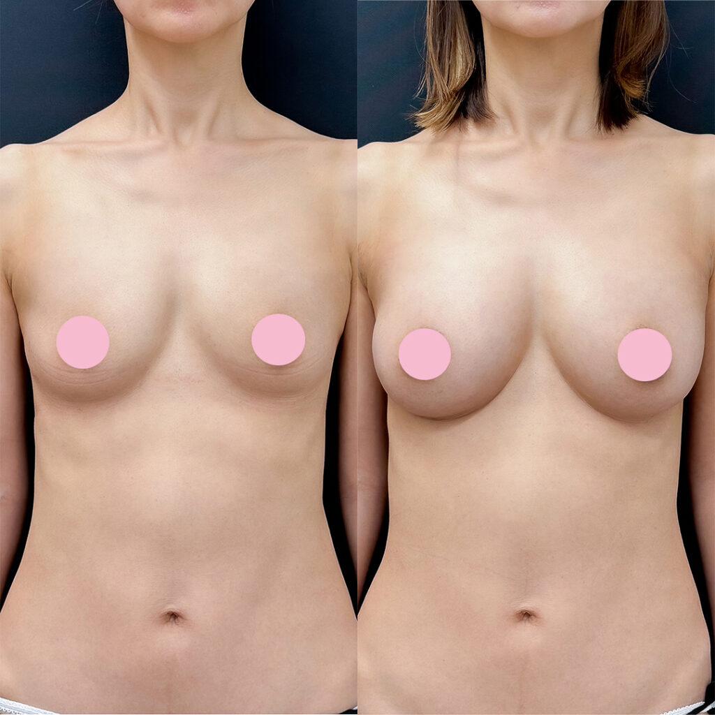 脂肪豊胸