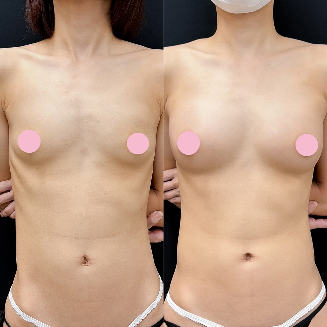 脂肪豊胸