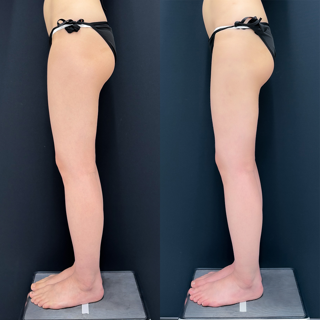https://purelys-tokyo-clinic.com/wp/wp-content/uploads/2025/10/leg-Liposuction_Case-No.101.jpg