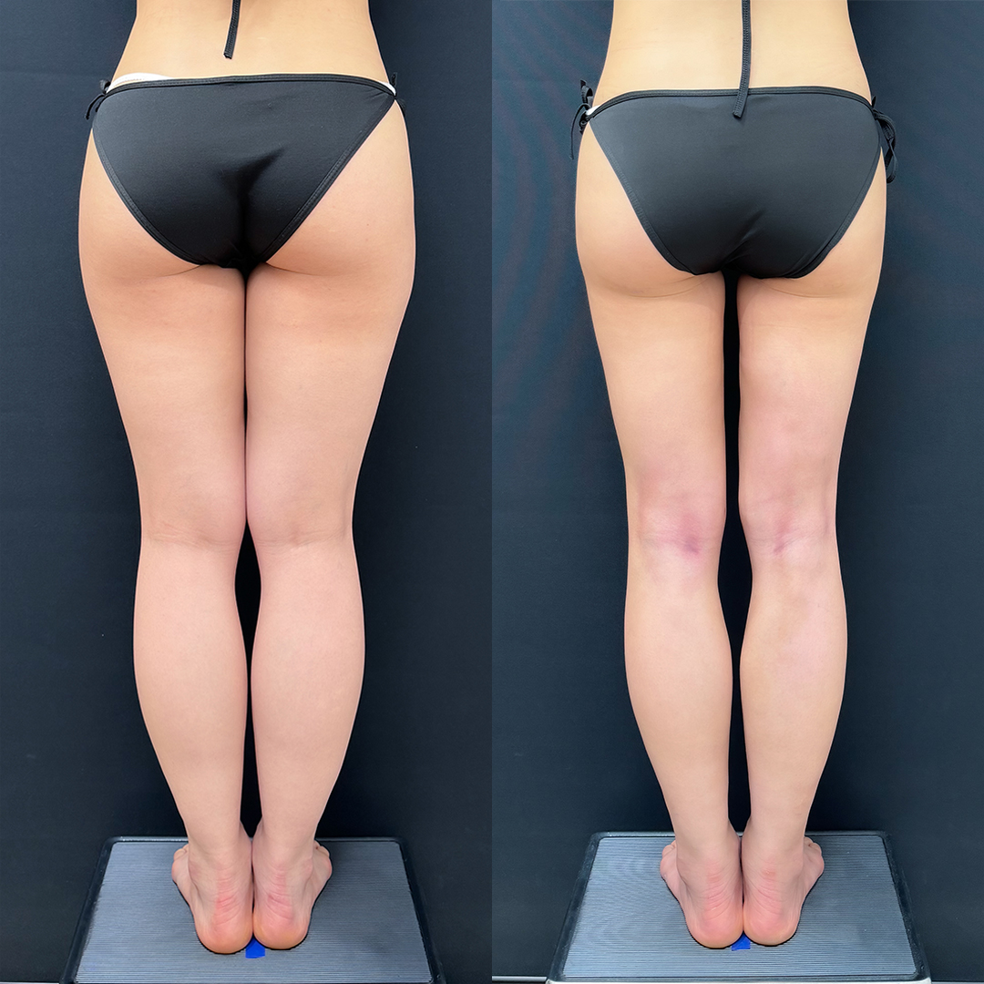 https://purelys-tokyo-clinic.com/wp/wp-content/uploads/2025/10/leg-Liposuction_Case-No.104.jpg