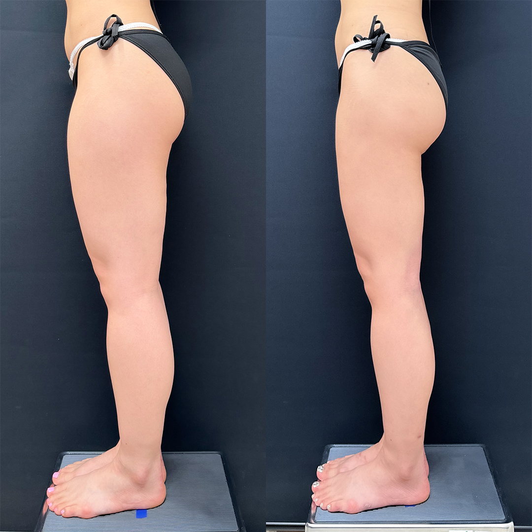 https://purelys-tokyo-clinic.com/wp/wp-content/uploads/2025/10/leg-Liposuction_Case-No.105.jpg