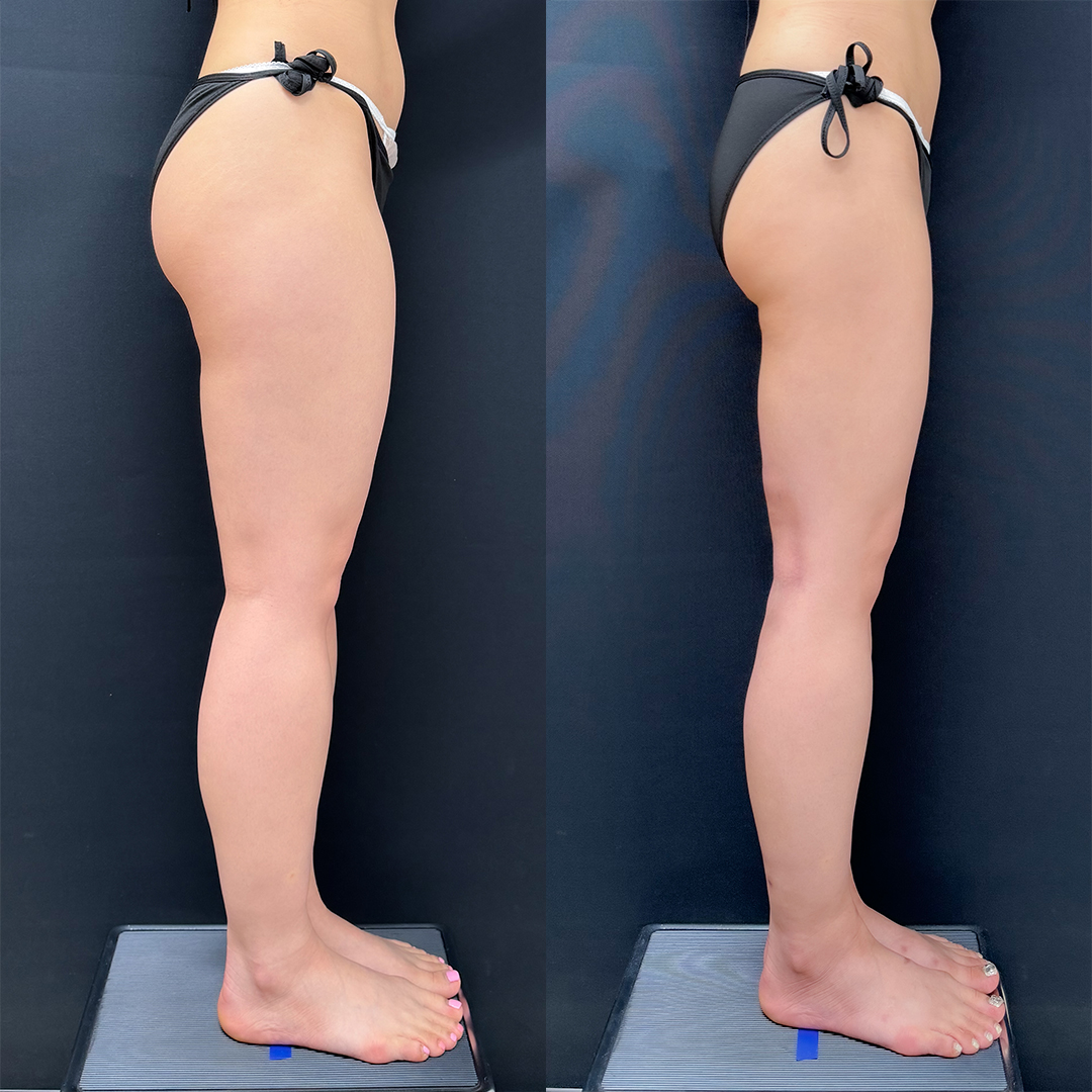 https://purelys-tokyo-clinic.com/wp/wp-content/uploads/2025/10/leg-Liposuction_Case-No.106.jpg