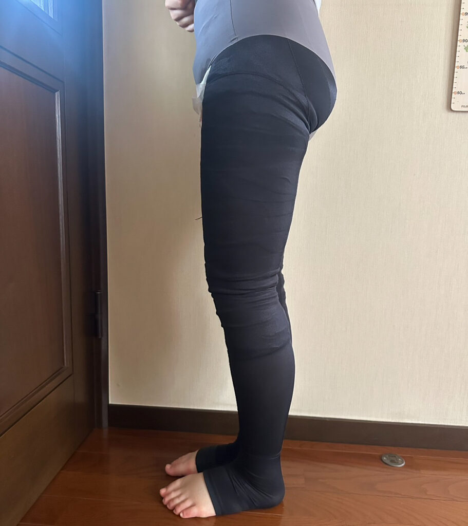 足の脂肪吸引