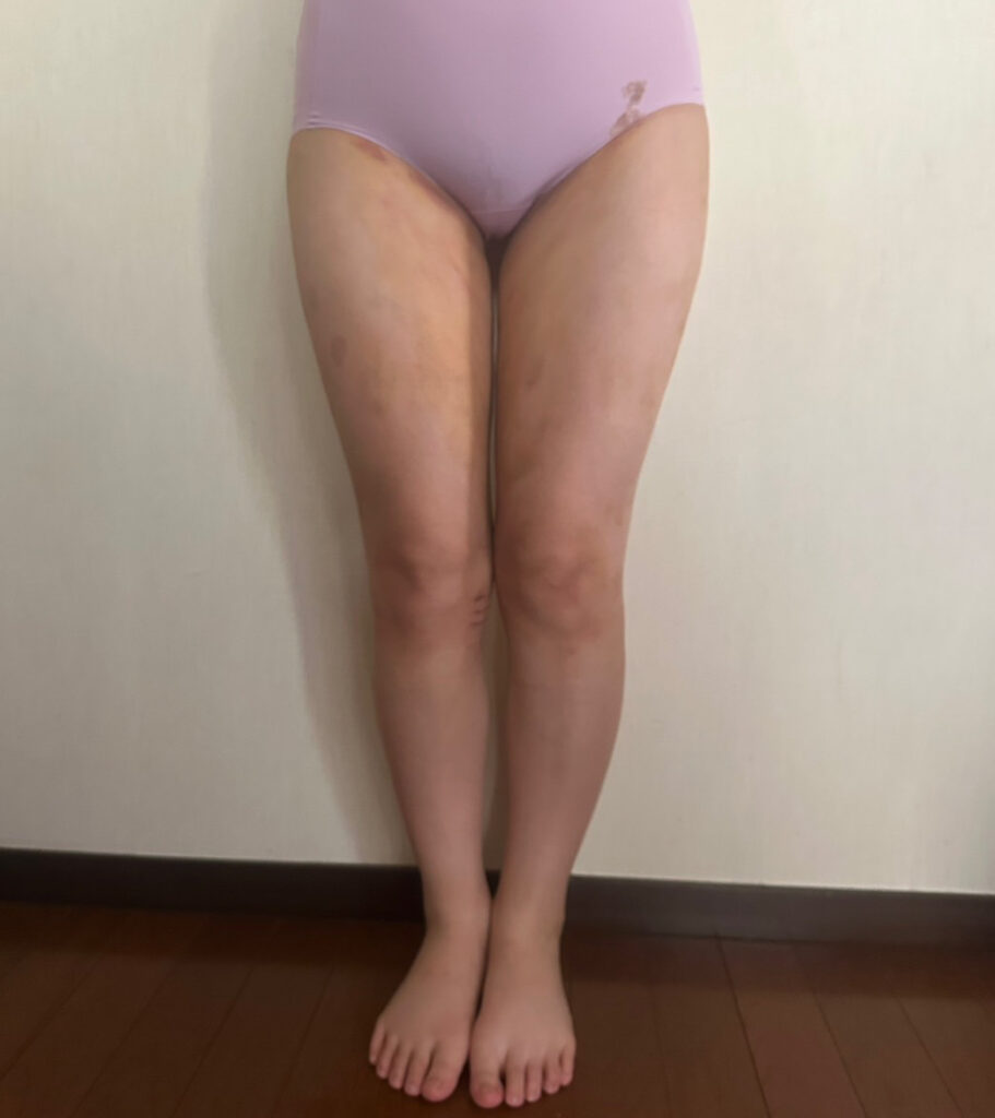 足の脂肪吸引