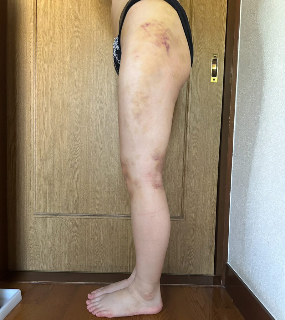 足の脂肪吸引