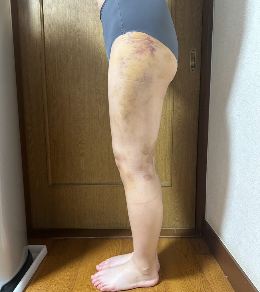足の脂肪吸引