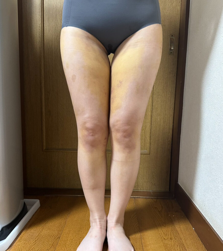 足の脂肪吸引