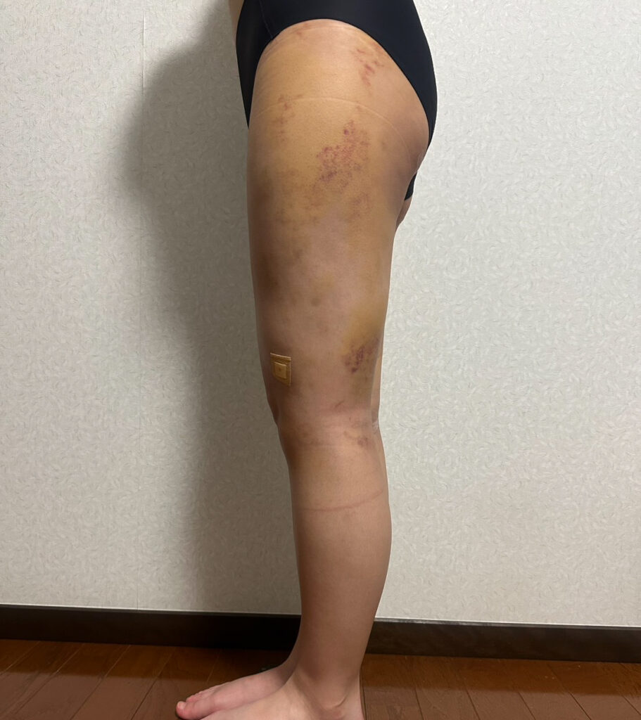 足の脂肪吸引