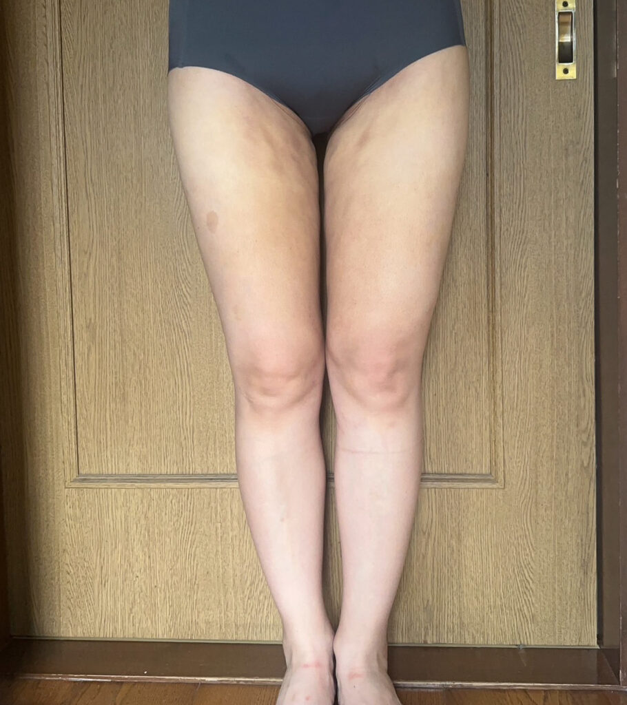 足の脂肪吸引