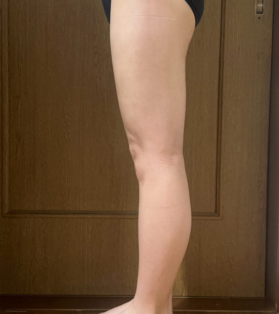 足の脂肪吸引