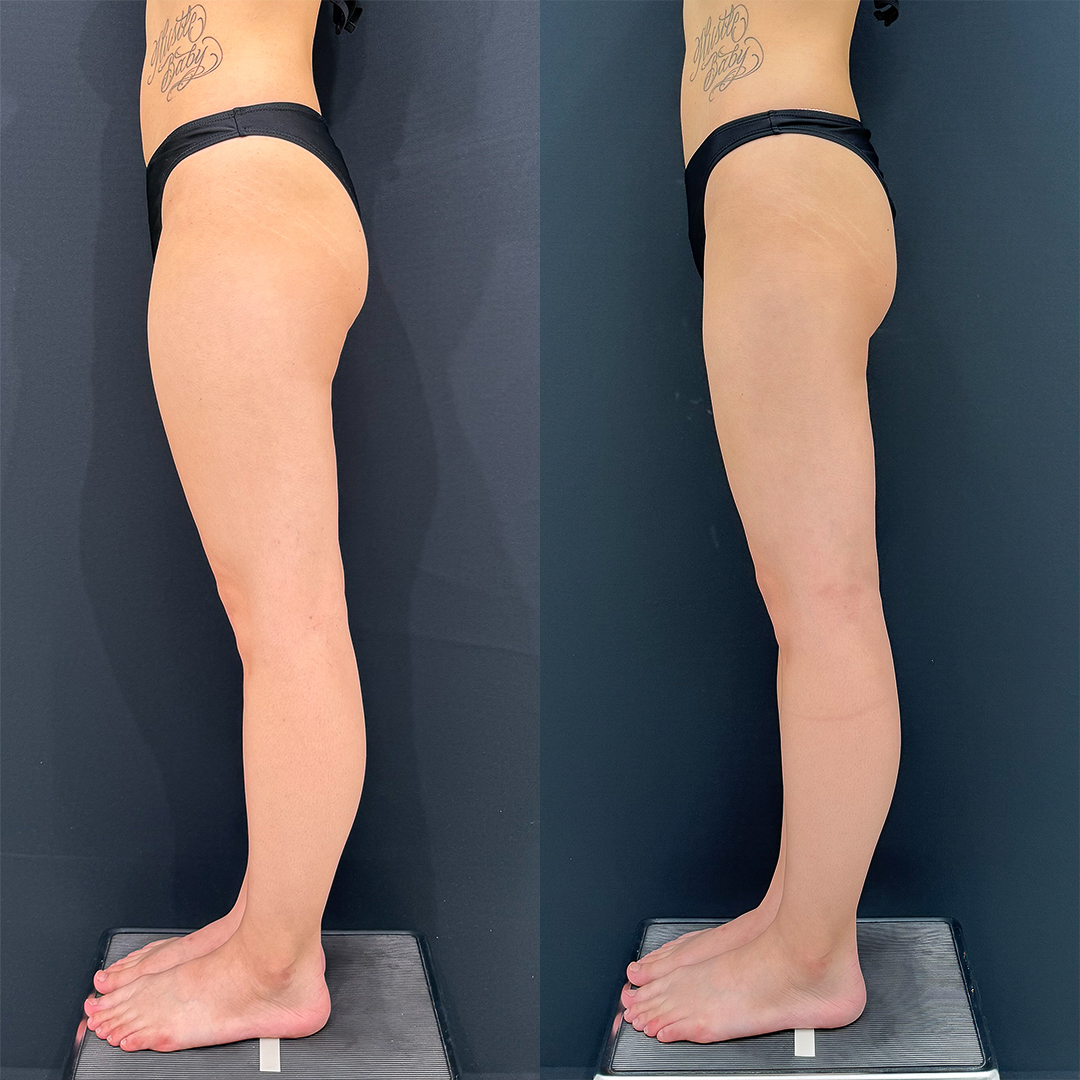 https://purelys-tokyo-clinic.com/wp/wp-content/uploads/2025/10/leg-Liposuction_Case-No.40.jpg