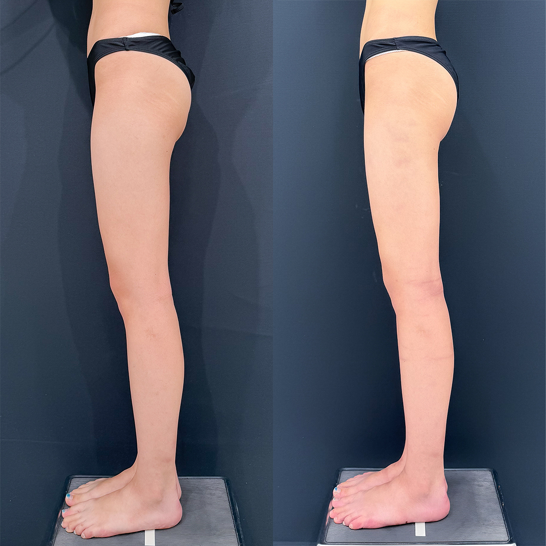 https://purelys-tokyo-clinic.com/wp/wp-content/uploads/2025/10/leg-Liposuction_Case-No.65.jpg