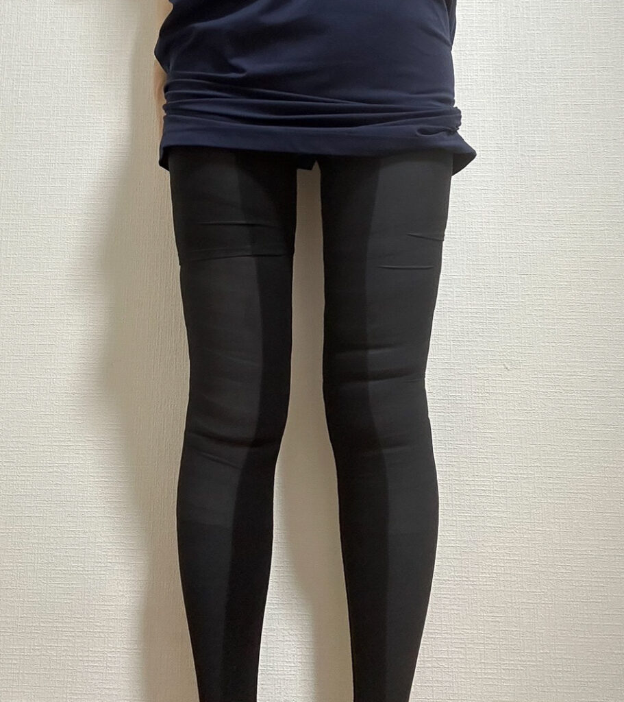 足の脂肪吸引