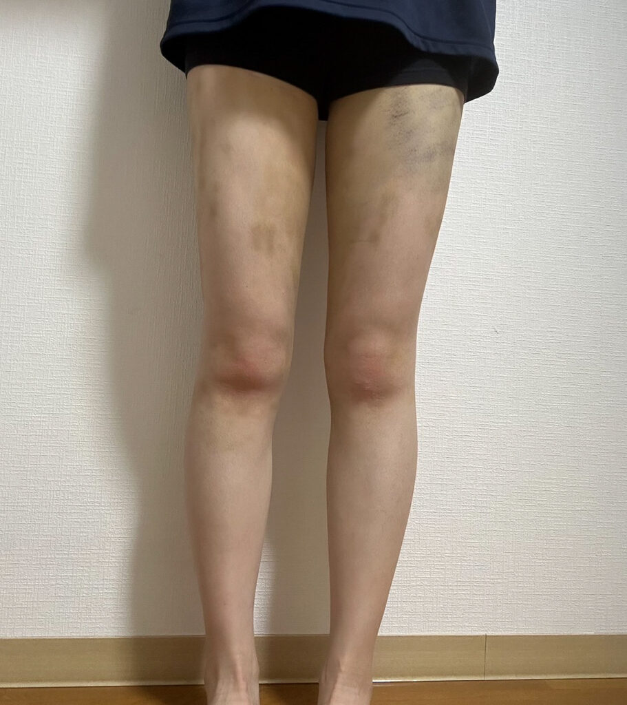 足の脂肪吸引
