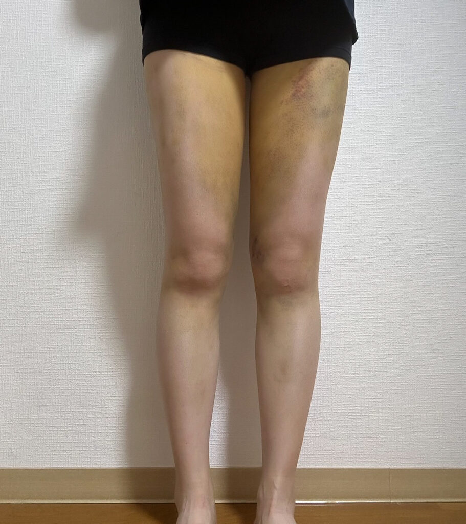 足の脂肪吸引