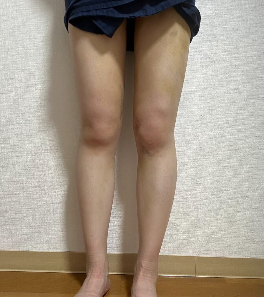 足の脂肪吸引