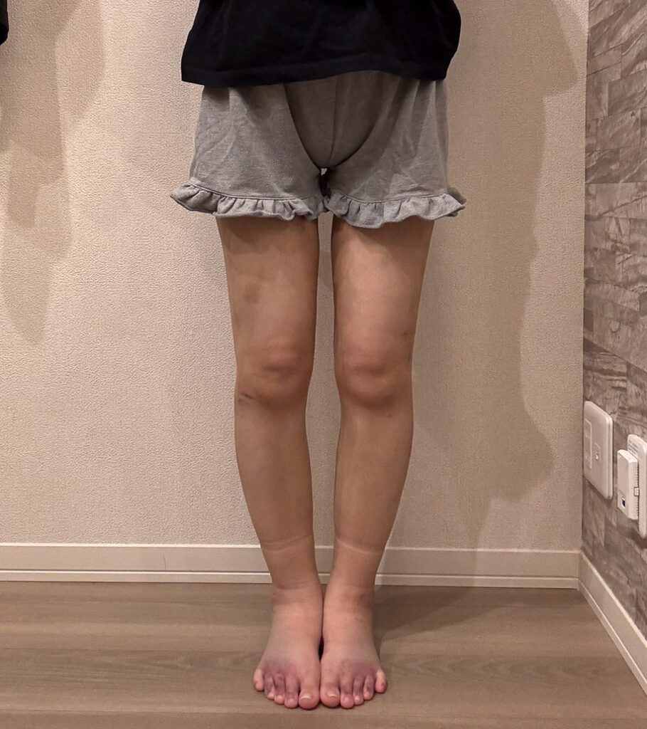 足の脂肪吸引