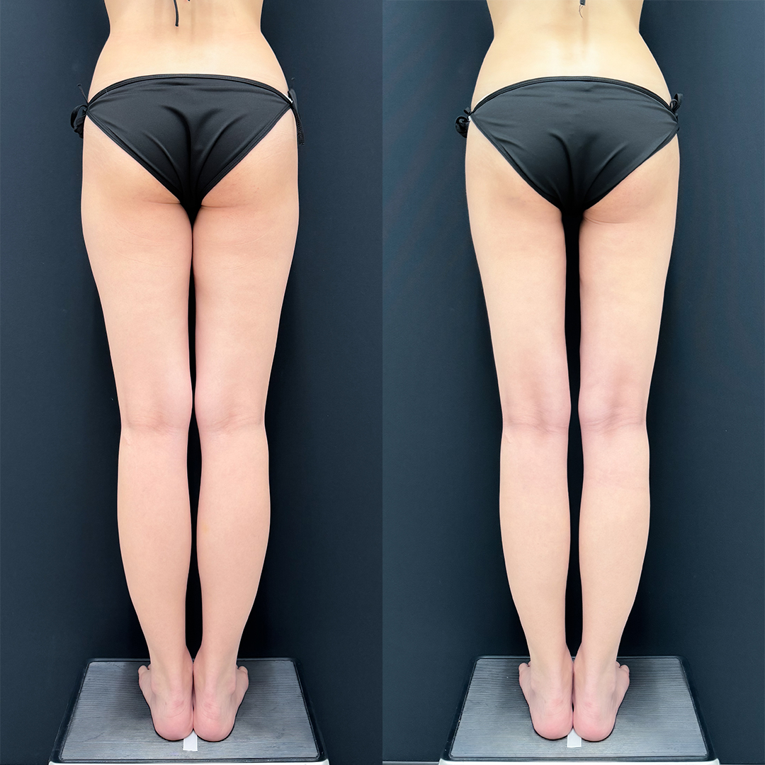 https://purelys-tokyo-clinic.com/wp/wp-content/uploads/2025/10/leg-Liposuction_Case-No.97.jpg