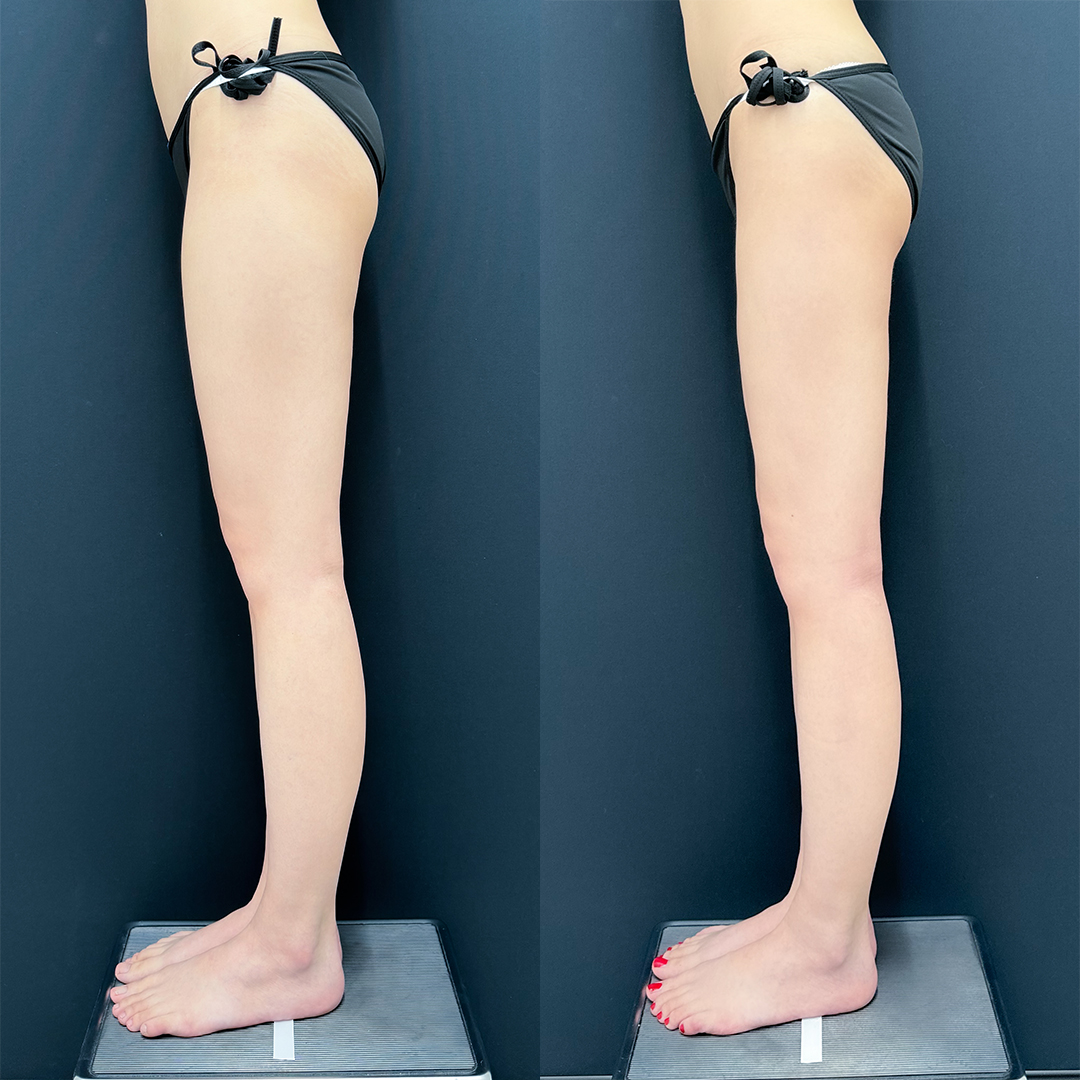 https://purelys-tokyo-clinic.com/wp/wp-content/uploads/2025/10/leg-Liposuction_Case-No.98.jpg
