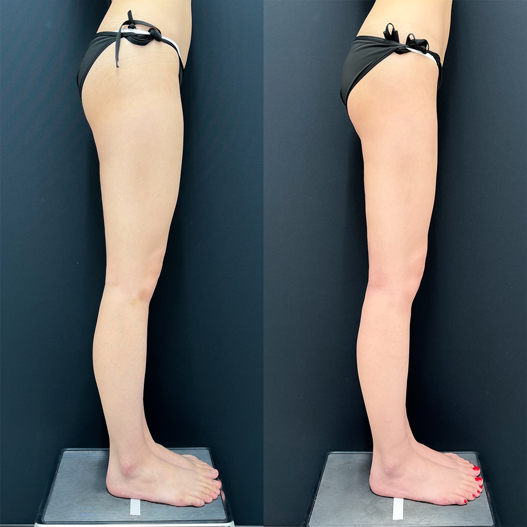 https://purelys-tokyo-clinic.com/wp/wp-content/uploads/2025/10/leg-Liposuction_Case-No.99.jpg