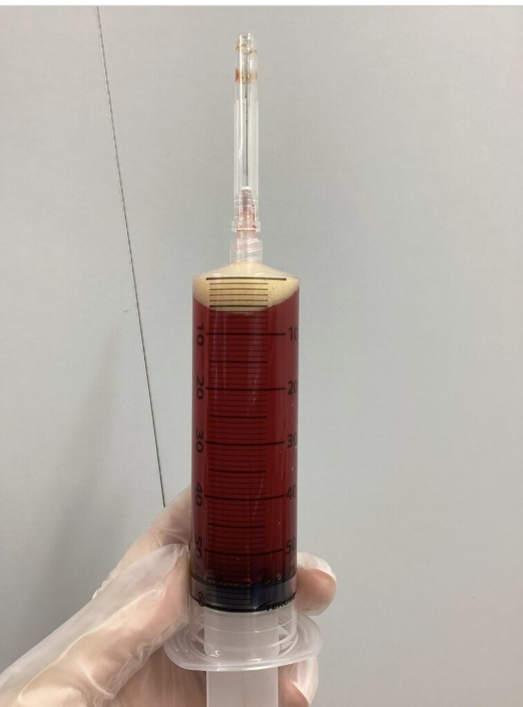 脂肪吸引の排液