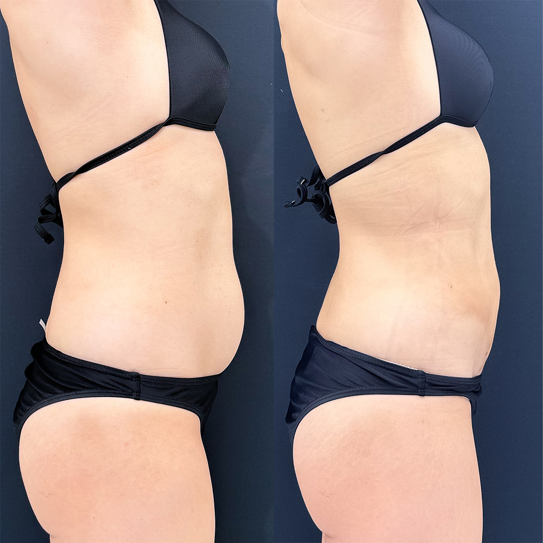https://purelys-tokyo-clinic.com/wp/wp-content/uploads/2025/11/Before-and-After-abdominal-Liposuction_Case-No.100-1.jpg
