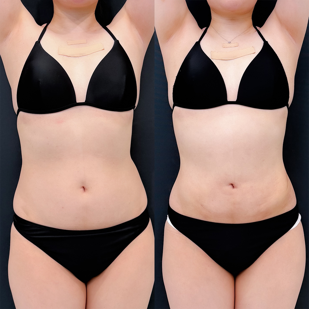 お腹の脂肪吸引