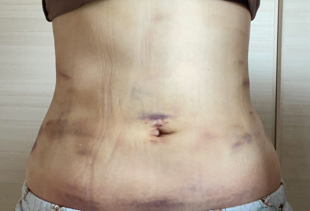 お腹の脂肪吸引