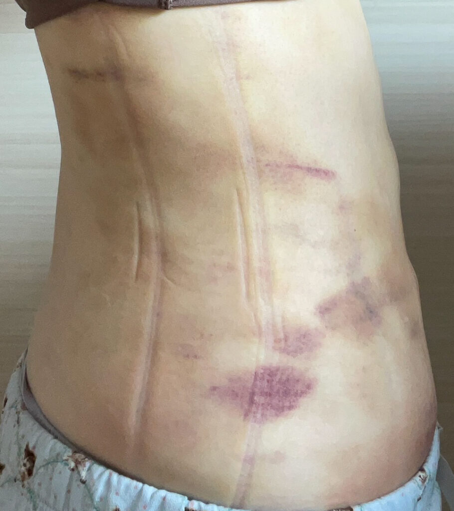 お腹の脂肪吸引