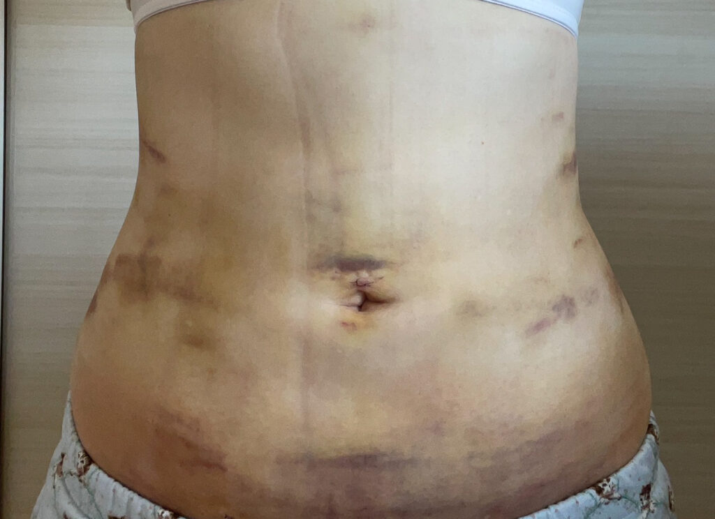 お腹の脂肪吸引