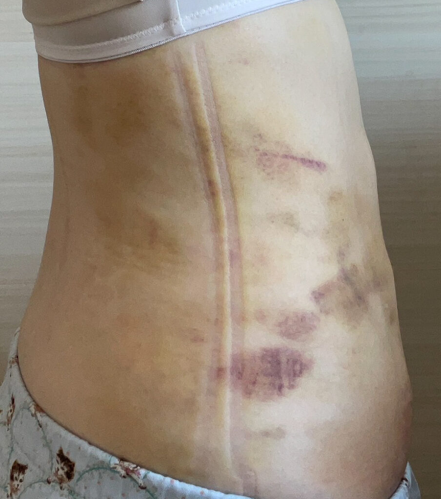 お腹の脂肪吸引