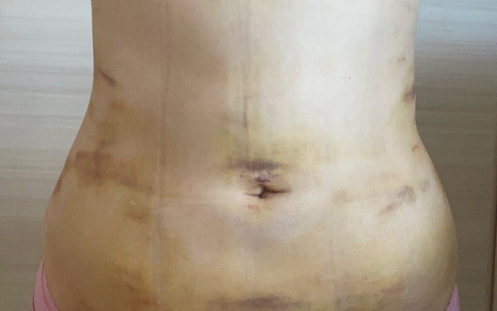 お腹の脂肪吸引