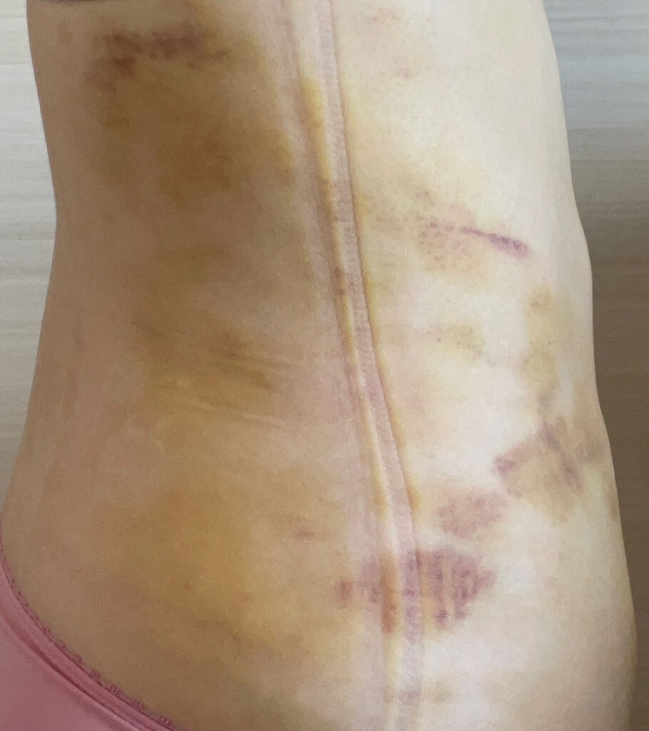 お腹の脂肪吸引