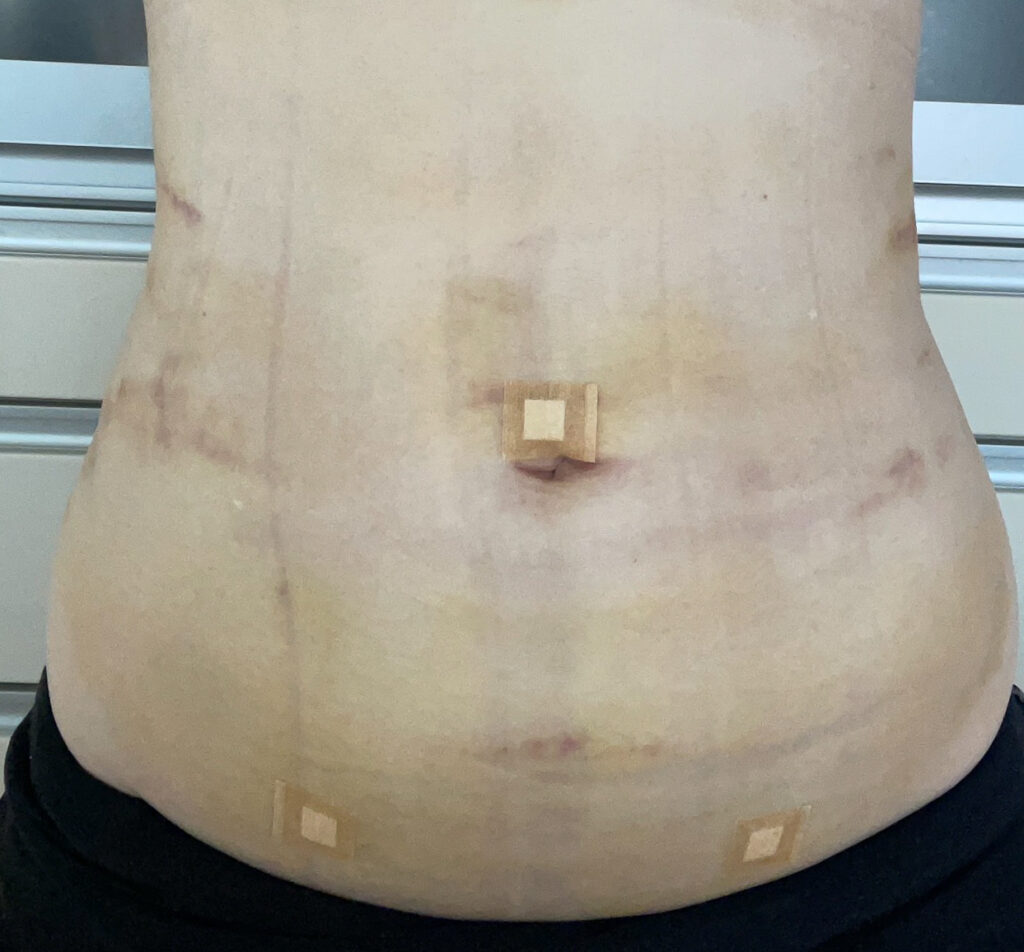 お腹の脂肪吸引