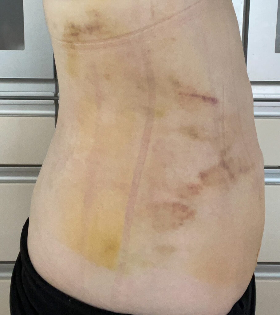 お腹の脂肪吸引