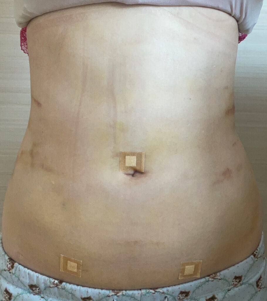 お腹の脂肪吸引