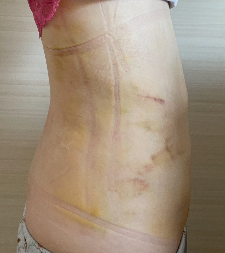 お腹の脂肪吸引